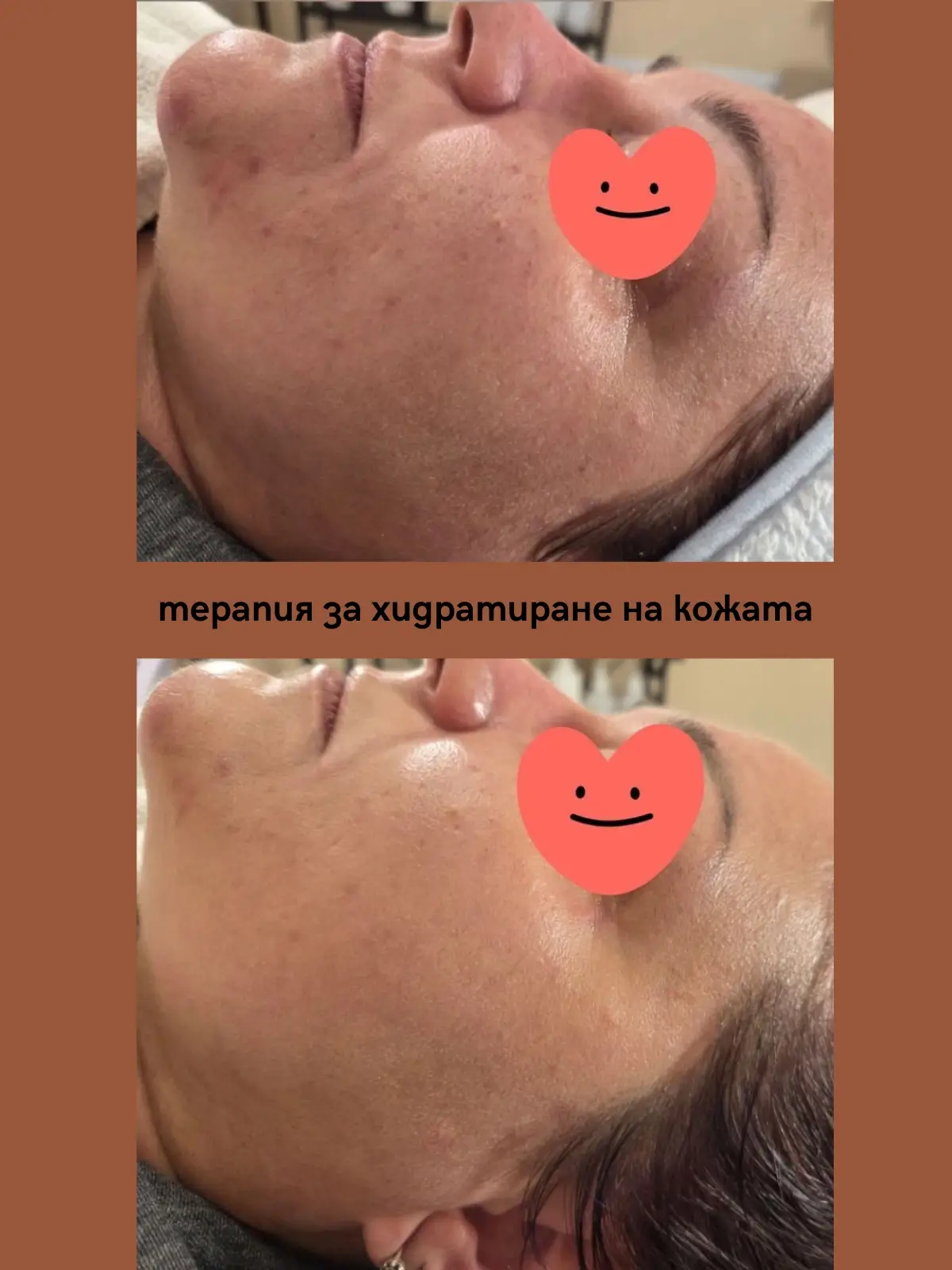 терапия за хидратиране на кожа (преди след ефект) от Вероника Богранова