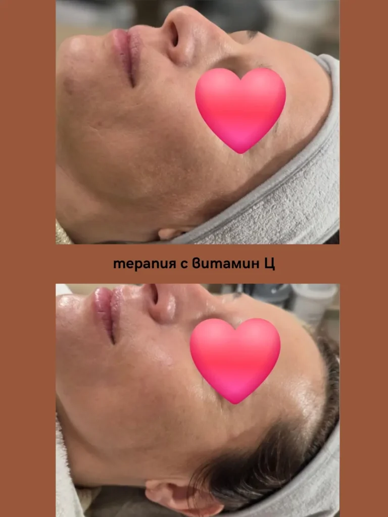 терапия на лице с Витамин Ц от Вероника (преди-след ефект)