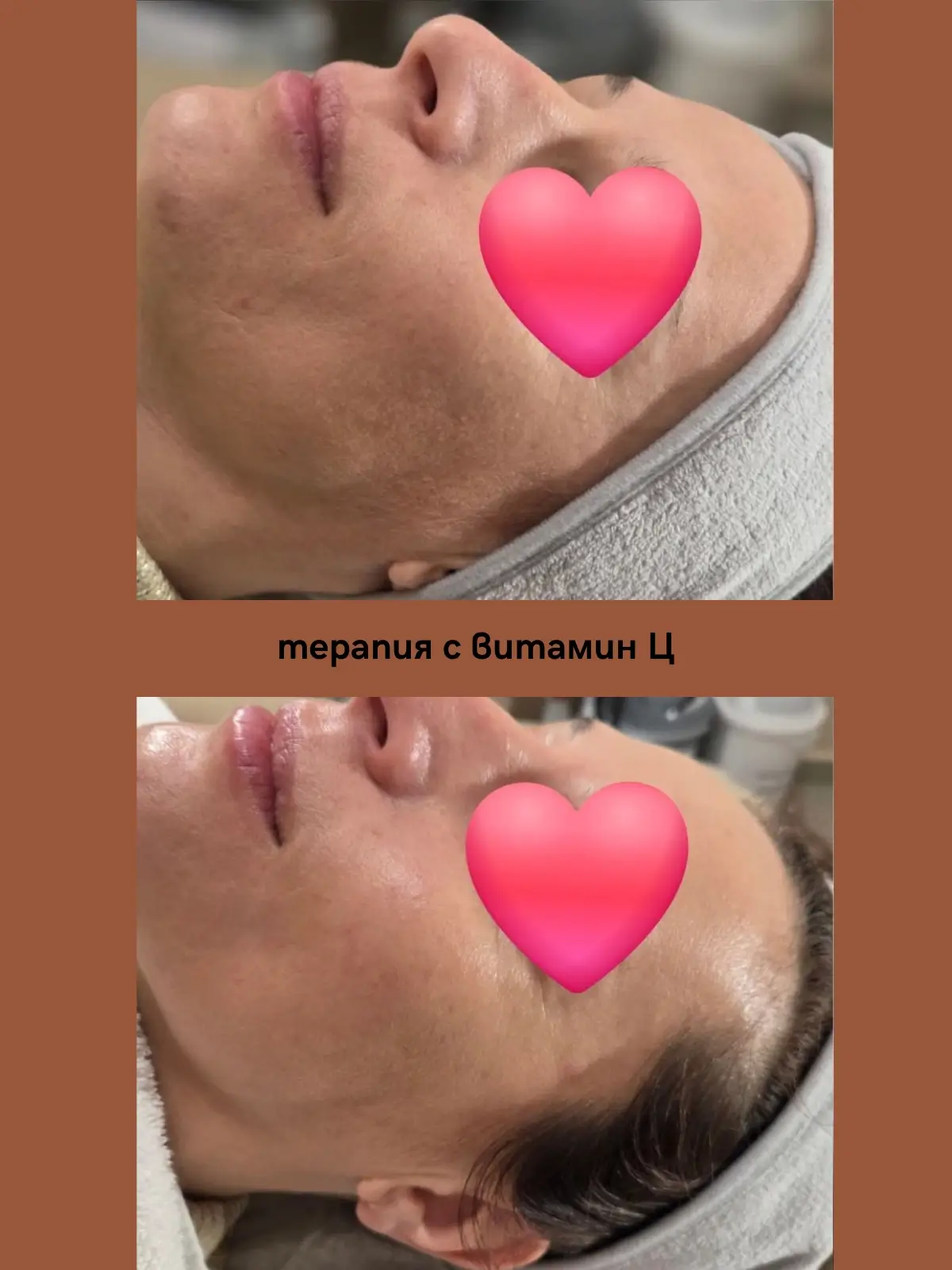 терапия на лице с Витамин Ц от Вероника (преди-след ефект)