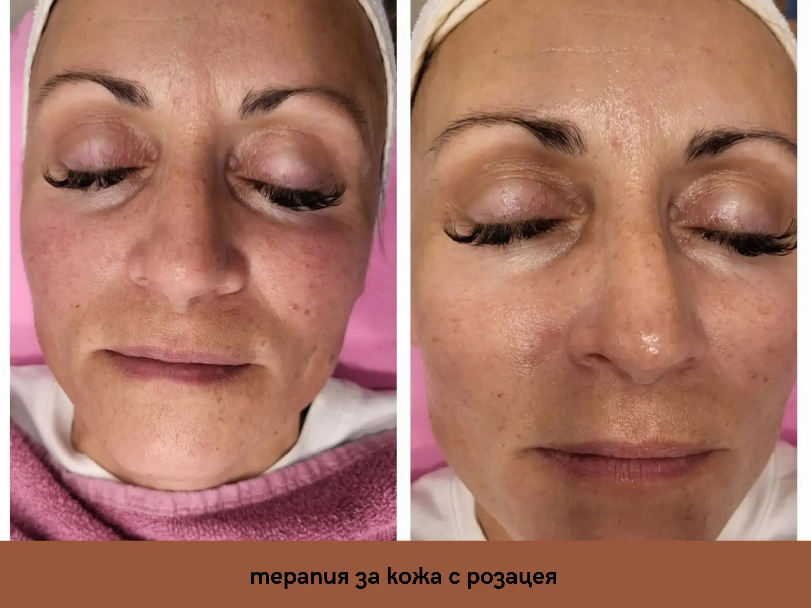 Терапия за лице с розацеа от Вероника (преди-след ефект)